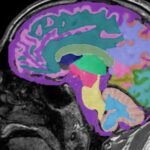 PERTAMA DI CNN: Perubahan gaya hidup yang dramatis dapat melawan Alzheimer tahap awal, kata sebuah studi. Begini caranya