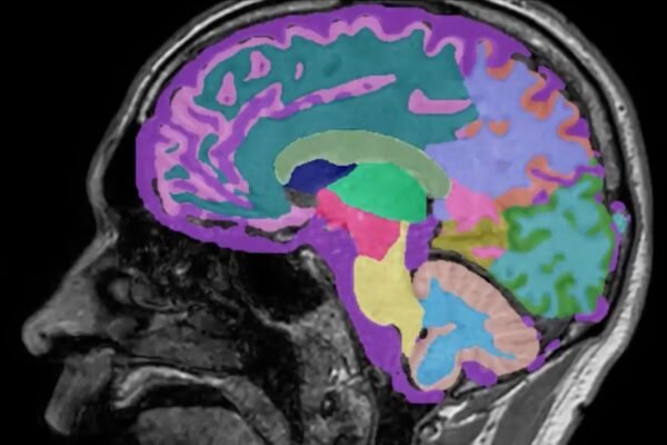 PERTAMA DI CNN: Perubahan gaya hidup yang dramatis dapat melawan Alzheimer tahap awal, kata sebuah studi. Begini caranya