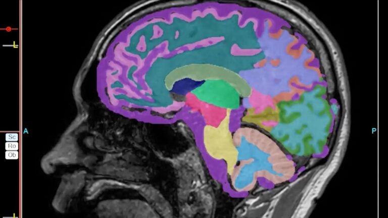 PERTAMA DI CNN: Perubahan gaya hidup yang dramatis dapat melawan Alzheimer tahap awal, kata sebuah studi. Begini caranya