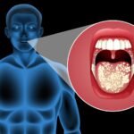 Onkolog menjelaskan bagaimana bahkan '1 gelas sehari' dapat secara perlahan meningkatkan risiko kanker mulut; membagikan tanda-tanda peringatan dini.