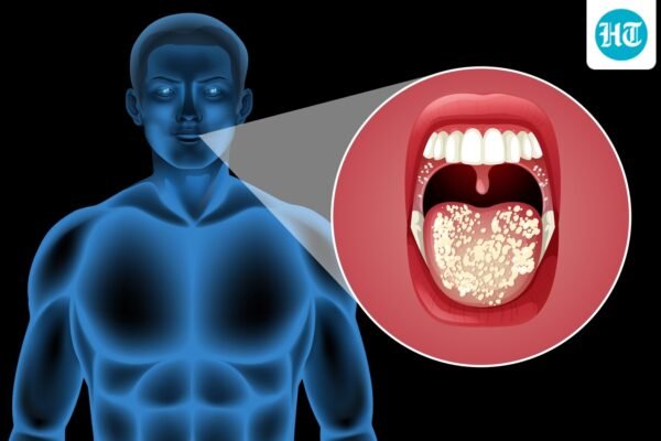 Onkolog menjelaskan bagaimana bahkan '1 gelas sehari' dapat secara perlahan meningkatkan risiko kanker mulut; membagikan tanda-tanda peringatan dini.