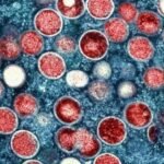 Penyakit Monkeypox di Amerika Serikat dan di Seluruh Dunia: Situasi Terkini