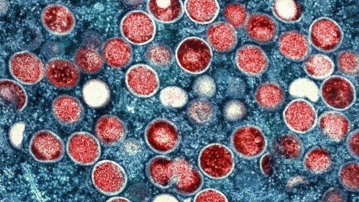 Penyakit Monkeypox di Amerika Serikat dan di Seluruh Dunia: Situasi Terkini